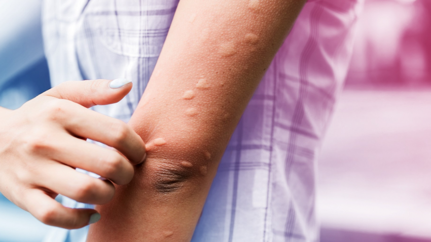 Alergia emocional na pandemia: o que é e como ela pode afetar a sua pele?  RADAR Sergipe - Notícias de Sergipe, Notícias de Aracaju